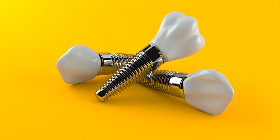 dental implant image